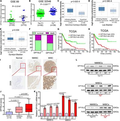 Dihydropyrimidinase Like 2 Promotes Bladder Cancer Progression via Pyruvate Kinase M2-Induced Aerobic Glycolysis and Epithelial–Mesenchymal Transition